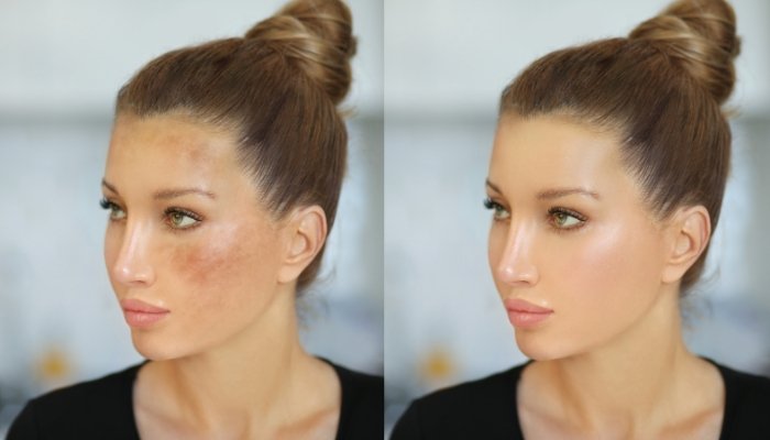 remove dark spots from face naturally