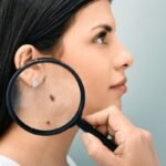 how to prevent moles