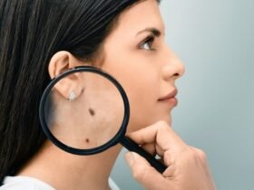 how to prevent moles