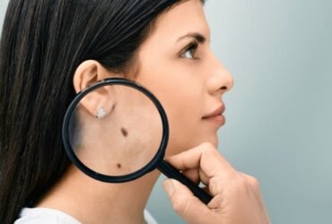 how to prevent moles