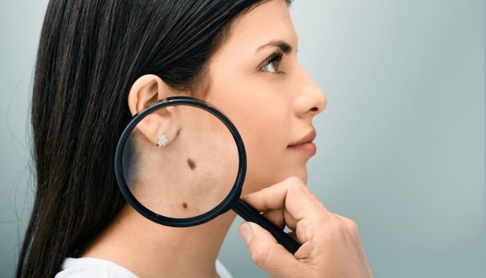 how to prevent moles