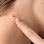 what causes skin tags