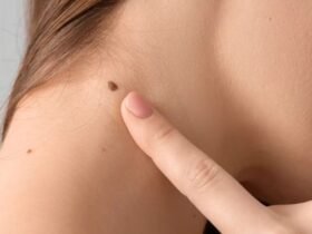 what causes skin tags