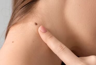 what causes skin tags