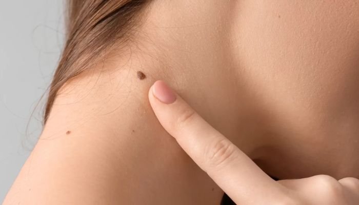 what causes skin tags